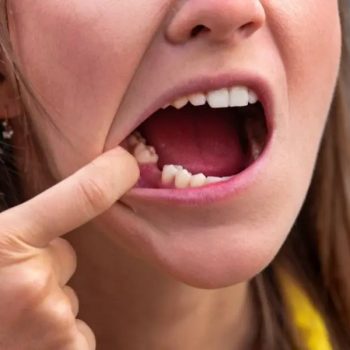 У дорослого зуби хитаються та випадають: що робити?