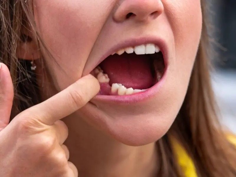 У дорослого зуби хитаються та випадають: що робити?